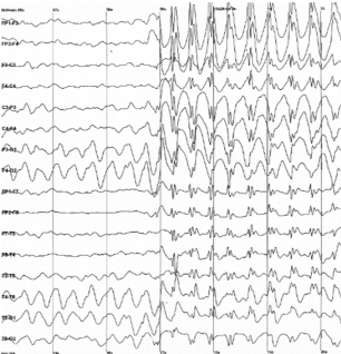 Raw output of EEG recording
