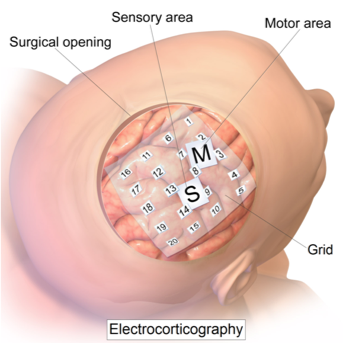 Image depicting electrodes placed on cortex for ECOG imaging.
