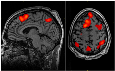 Image of an fMRI scan with red sections indicating areas of the brain that are more active than the control condition.